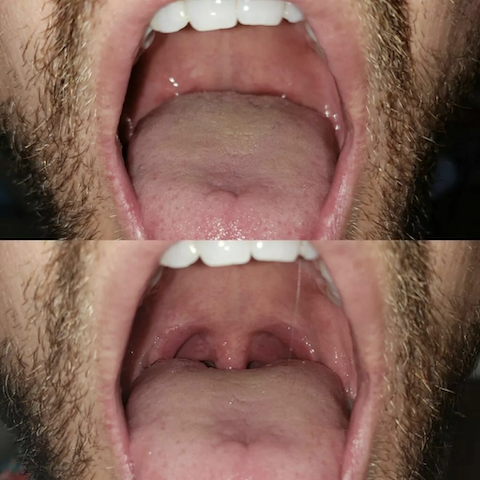 Easier Breathing Before and After Nightlase Treatment