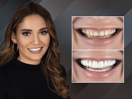 woman smiling veneers before and after