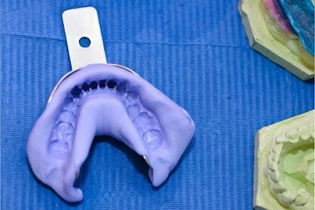 A mail order aligner with imprinted teeth.