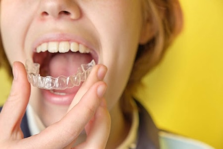 A girl wearing her Invisalign invisible braces.