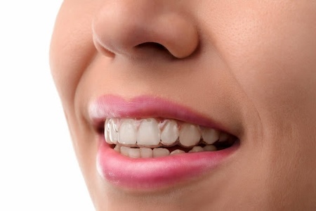 A teen girl showing her Invisalign Invisible braces.