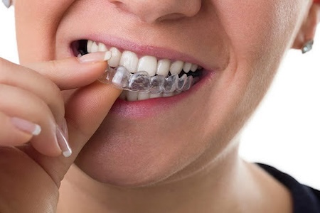 A woman wearing her Invisalign braces.