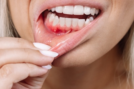 A female with swollen gums due to gingivitis and gum recession.